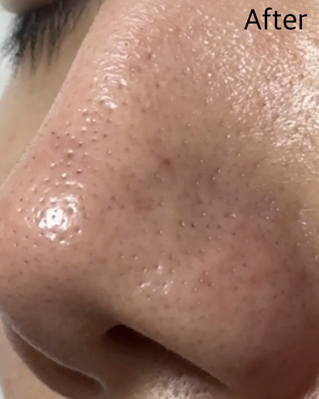 녹두 모공 스케일링 워터 이미지 2